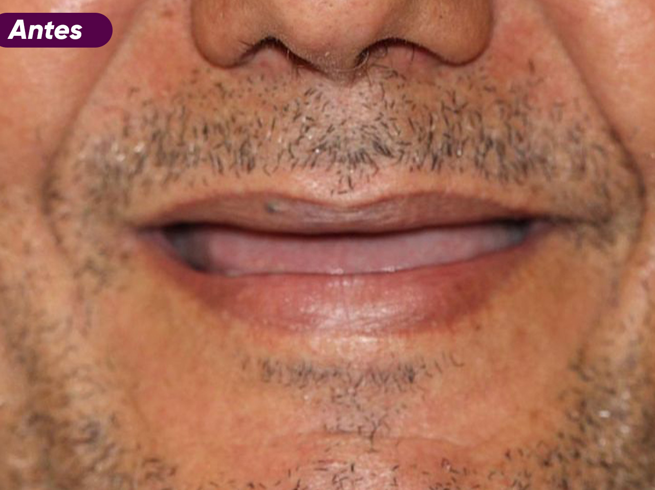 ANTES
