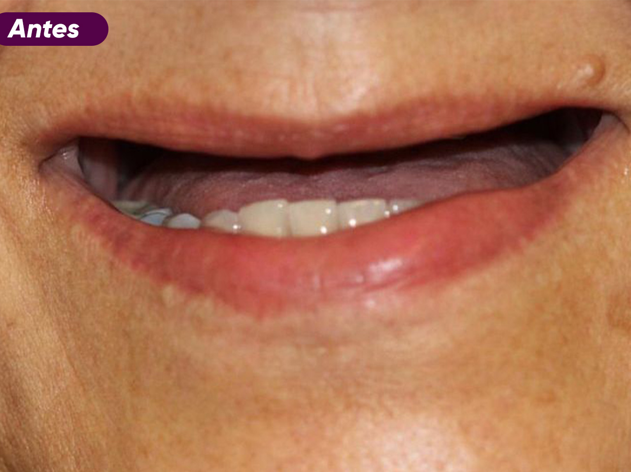 ANTES